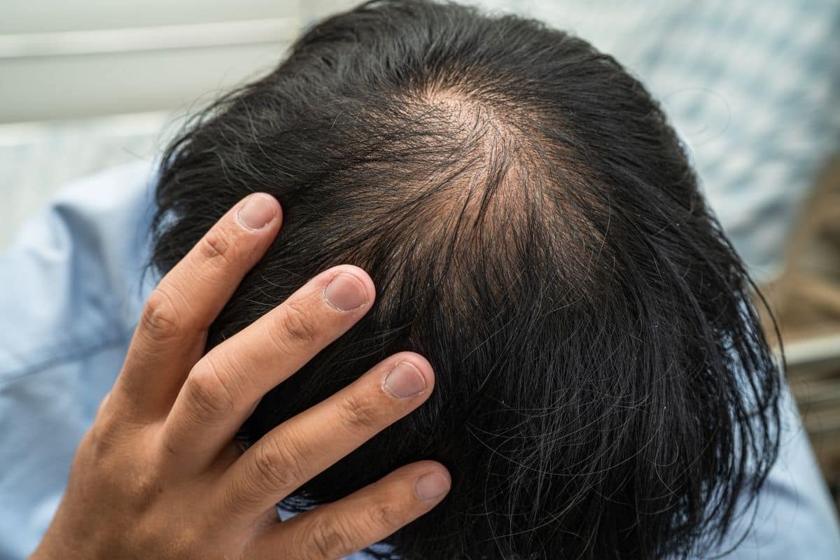 calvitie precoce perte de cheveux par plaque