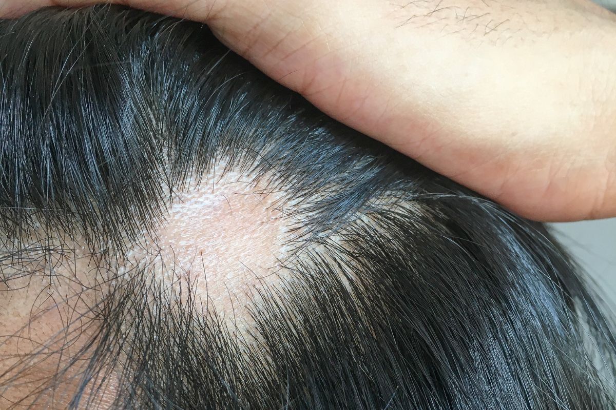 alopecia aerata homme