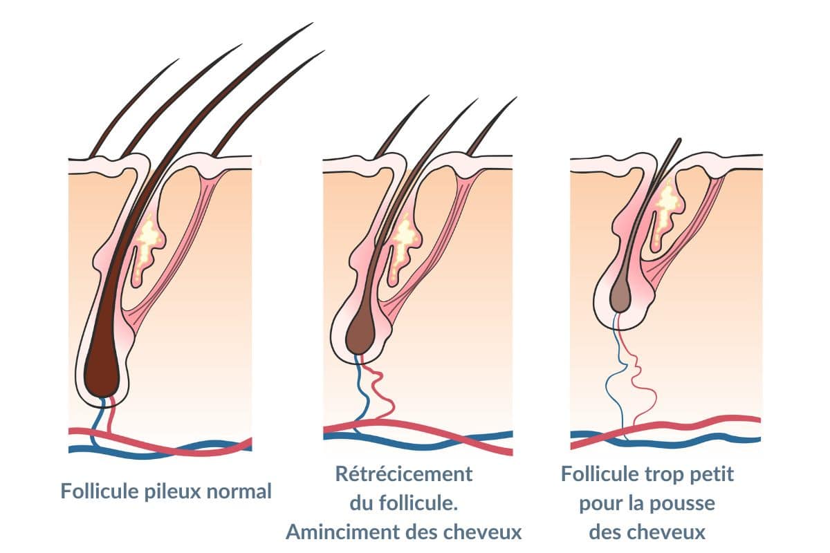 dht perte de cheveux y remedier