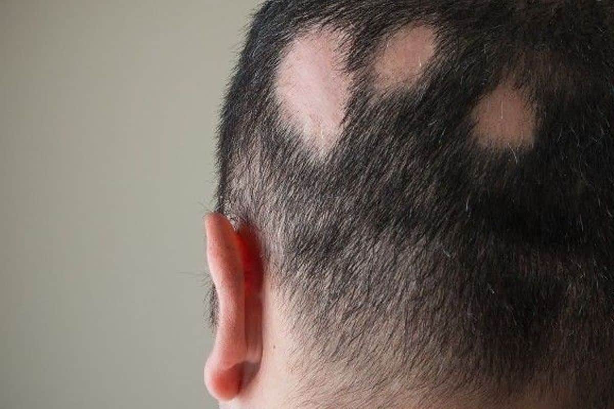 pelade homme des solutions efficaces pour retrouver des cheveux